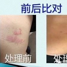带状疱疹案例-原始点全球同学网