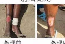 脚部皮肤癌案例(辛巴威探访)(简体版)-原始点全球同学网