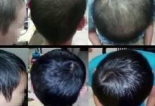 少年脱发案例（简体版）-原始点全球同学网