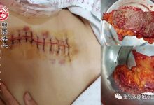 大肠癌肝转移案例-原始点全球同学网