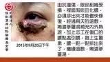 眼部遭门撞伤案例-原始点全球同学网
