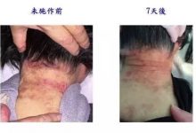 严重皮肤病案例-原始点全球同学网