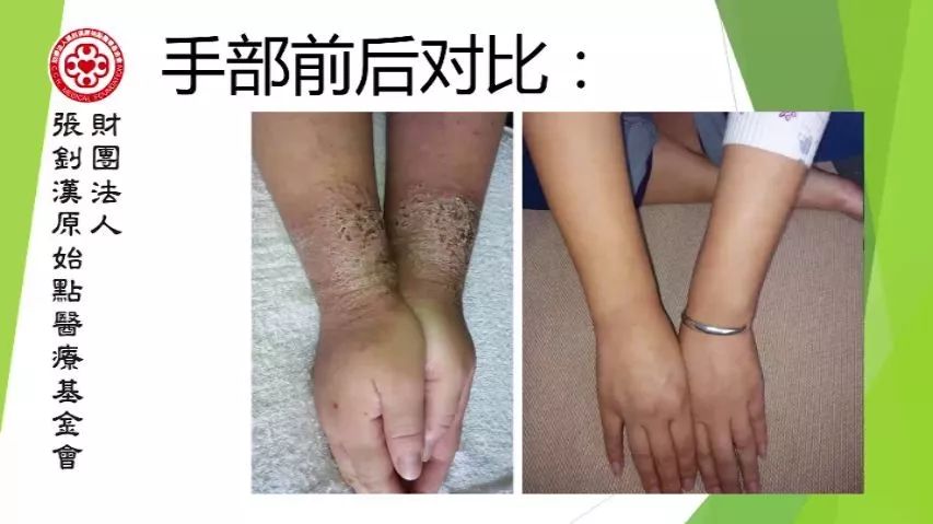 严重湿疹案例（青岛）-原始点全球同学网