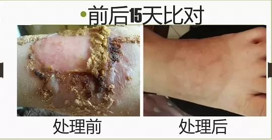 脚烫伤15天完全修复案例(简体版) 脚烫伤15天完全修复案例(简体版)