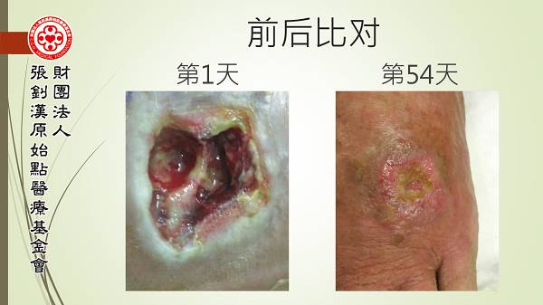 脚部伤口案例(简体版) 脚部伤口案例(简体版)