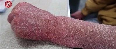 50年干癣案例 影响生活机能，运用原始点五宝，改善困扰2019.3-原始点全球同学网