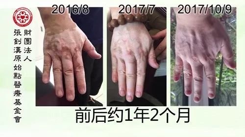 白癜风案例--2017.11最新案例 白癜风案例--2017.11最新案例