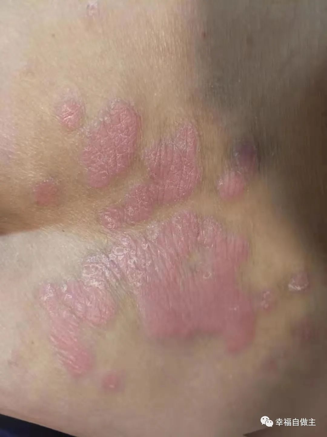 十年牛皮癣6个月基本恢复案例 十年牛皮癣6个月基本恢复案例