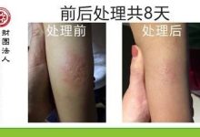 不明生物咬伤案例-原始点全球同学网