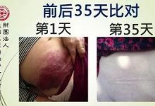 腹部肿胀案例-原始点全球同学网