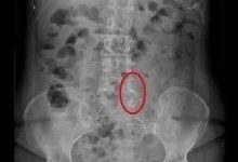 腰椎骨刺案例-原始点全球同学网