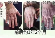 白癜风案例--2017.11最新案例-原始点全球同学网