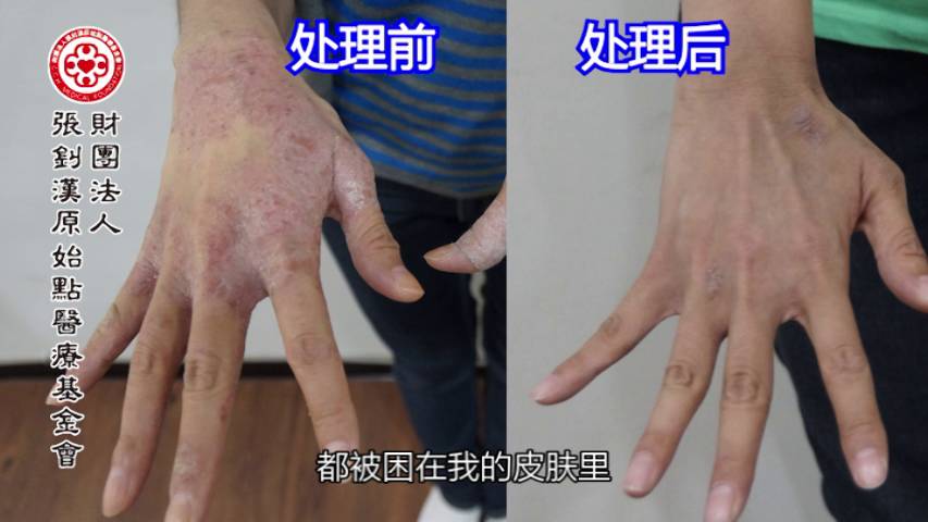 异位性皮肤炎案例(王小姐)（简体版）-2017.8最新案例