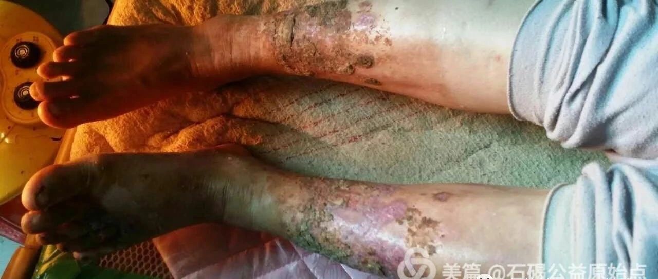 高血糖，双腿腐烂不愈合，西医认为需截肢-原始点全球同学网