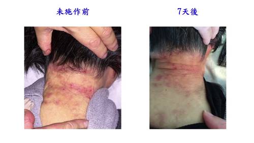 严重皮肤病案例 严重皮肤病案例