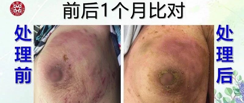 乳腺及淋巴肿块案例-原始点全球同学网
