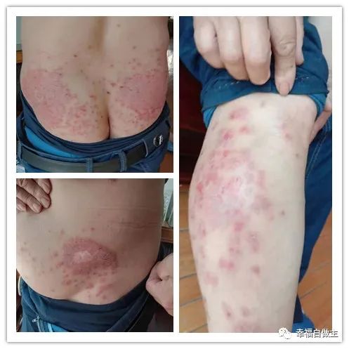 十年牛皮癣6个月基本恢复案例 十年牛皮癣6个月基本恢复案例