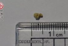 结石自然排出案例-2017.8最新案例-原始点全球同学网