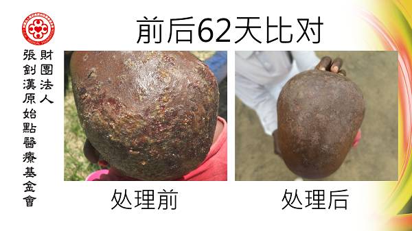 头部感染案例(辛巴威小女孩探访)(简体版) 头部感染案例(辛巴威小女孩探访)(简体版)