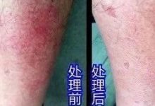 肌肉发炎案例-原始点全球同学网