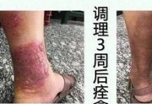 蜂窝性组织炎案例-原始点全球同学网