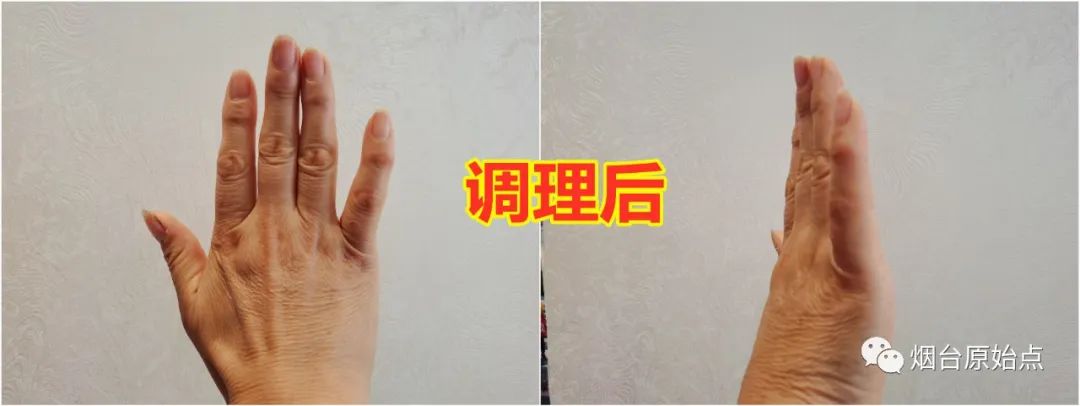 手指弯曲不能伸直、上背部发麻案例