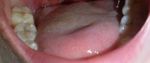 痛风案例、扁桃体化脓案例、腹泻多日肛门塞姜丸案例-原始点全球同学网