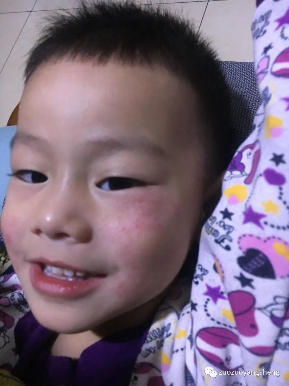 案例分享:原始点调理小孩湿疹的案例 案例分享:原始点调理小孩湿疹的案例