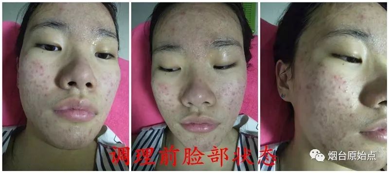 脸部痘痘案例 脸部痘痘案例