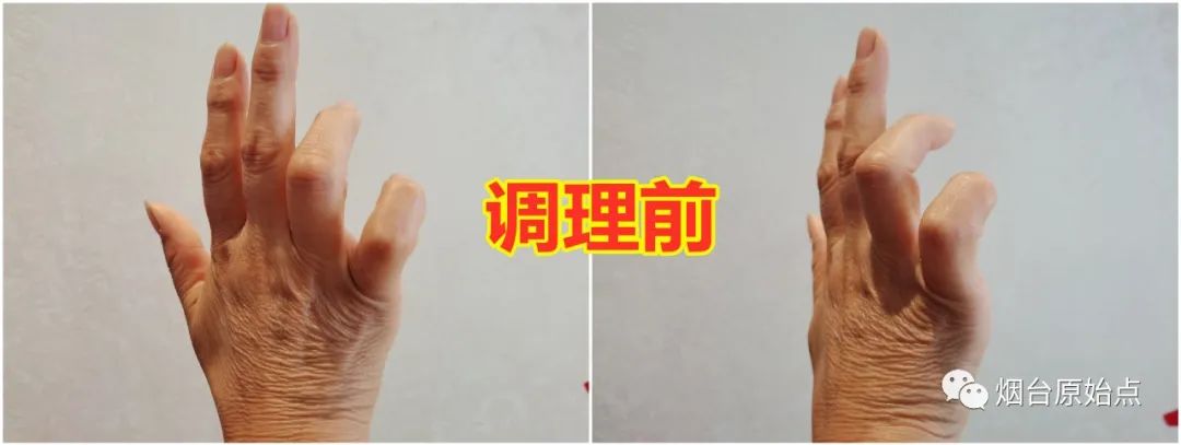 手指弯曲不能伸直、上背部发麻案例