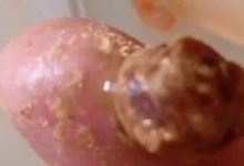 手指头血管瘤案例-原始点全球同学网