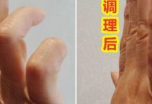 手指弯曲不能伸直、上背部发麻案例-原始点全球同学网