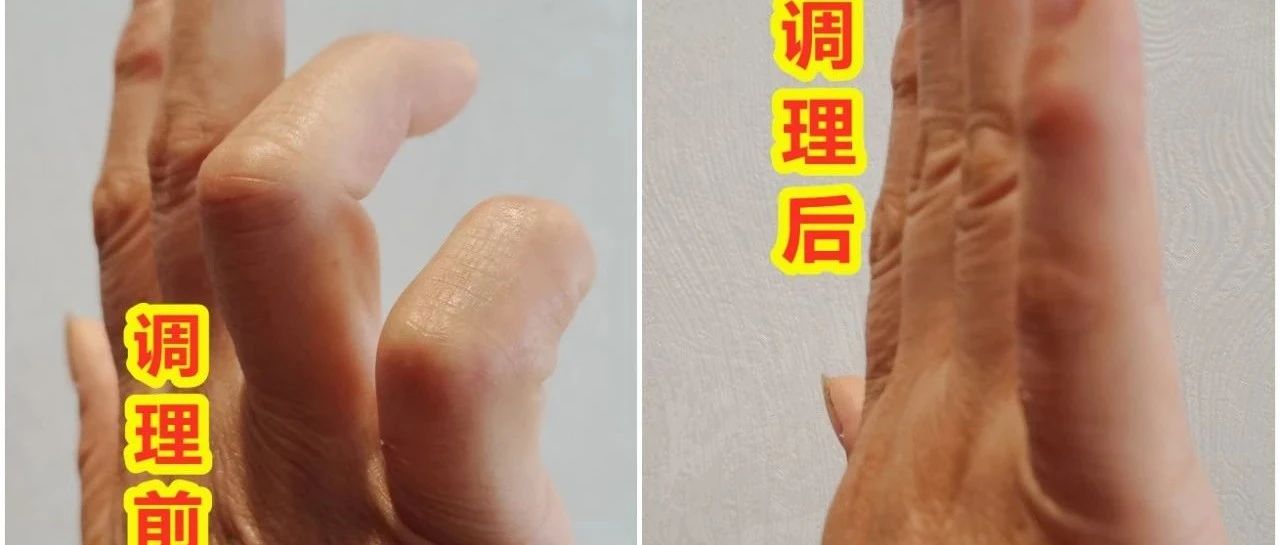 手指弯曲不能伸直、上背部发麻案例-原始点全球同学网