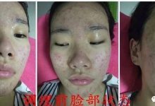 脸部痘痘案例-原始点全球同学网