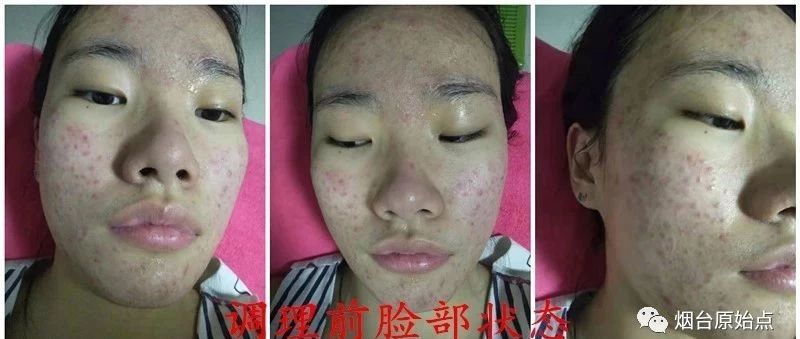 脸部痘痘案例-原始点全球同学网