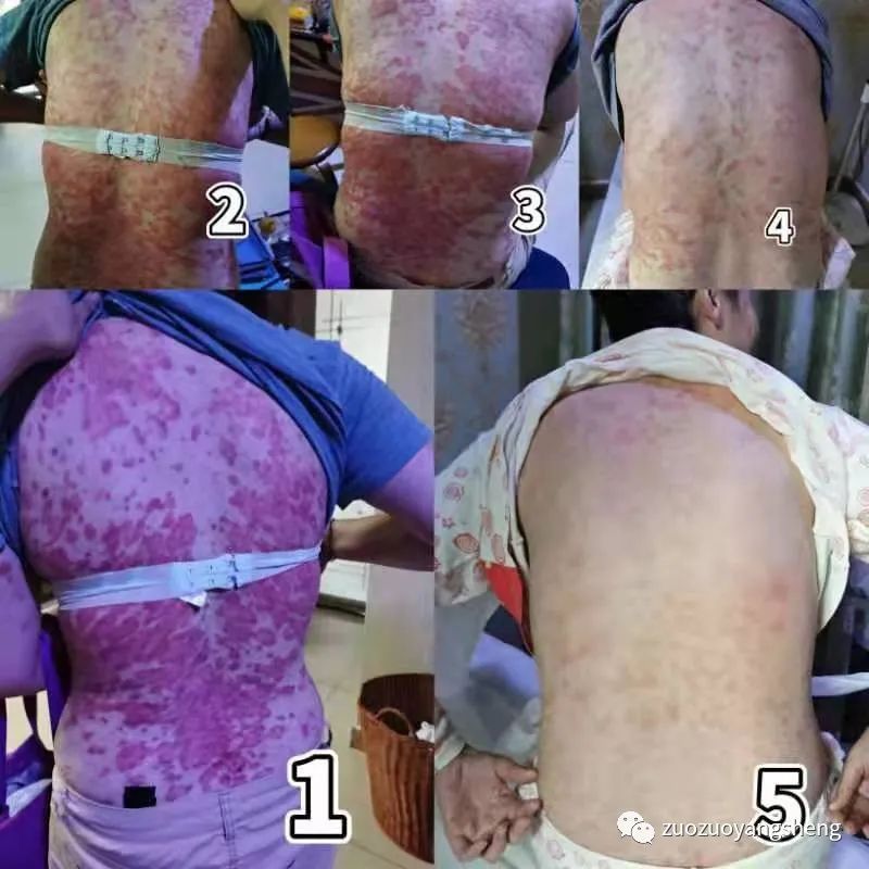 案例分享:原始点调理20多年牛皮癣案例 案例分享:原始点调理20多年牛皮癣案例