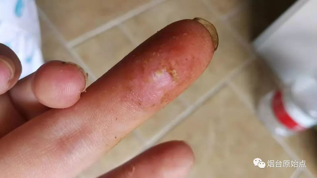 手指头血管瘤案例