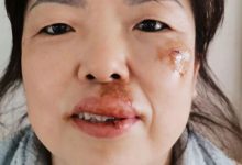 脸部摔伤案例-原始点全球同学网