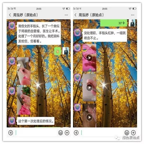 手指头血管瘤案例