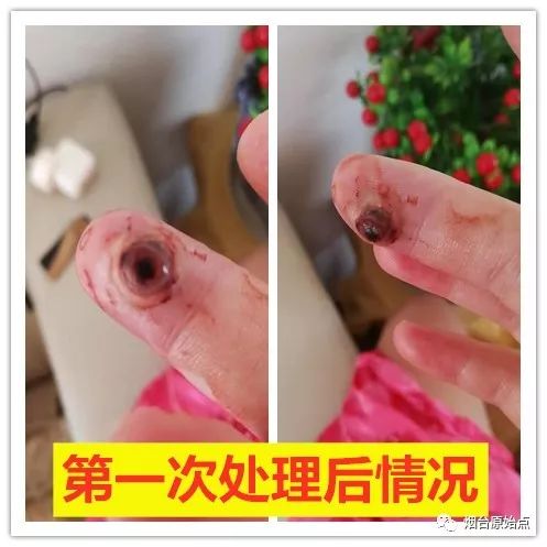 手指头血管瘤案例