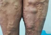 原始点案例:静脉曲张案例集-原始点全球同学网