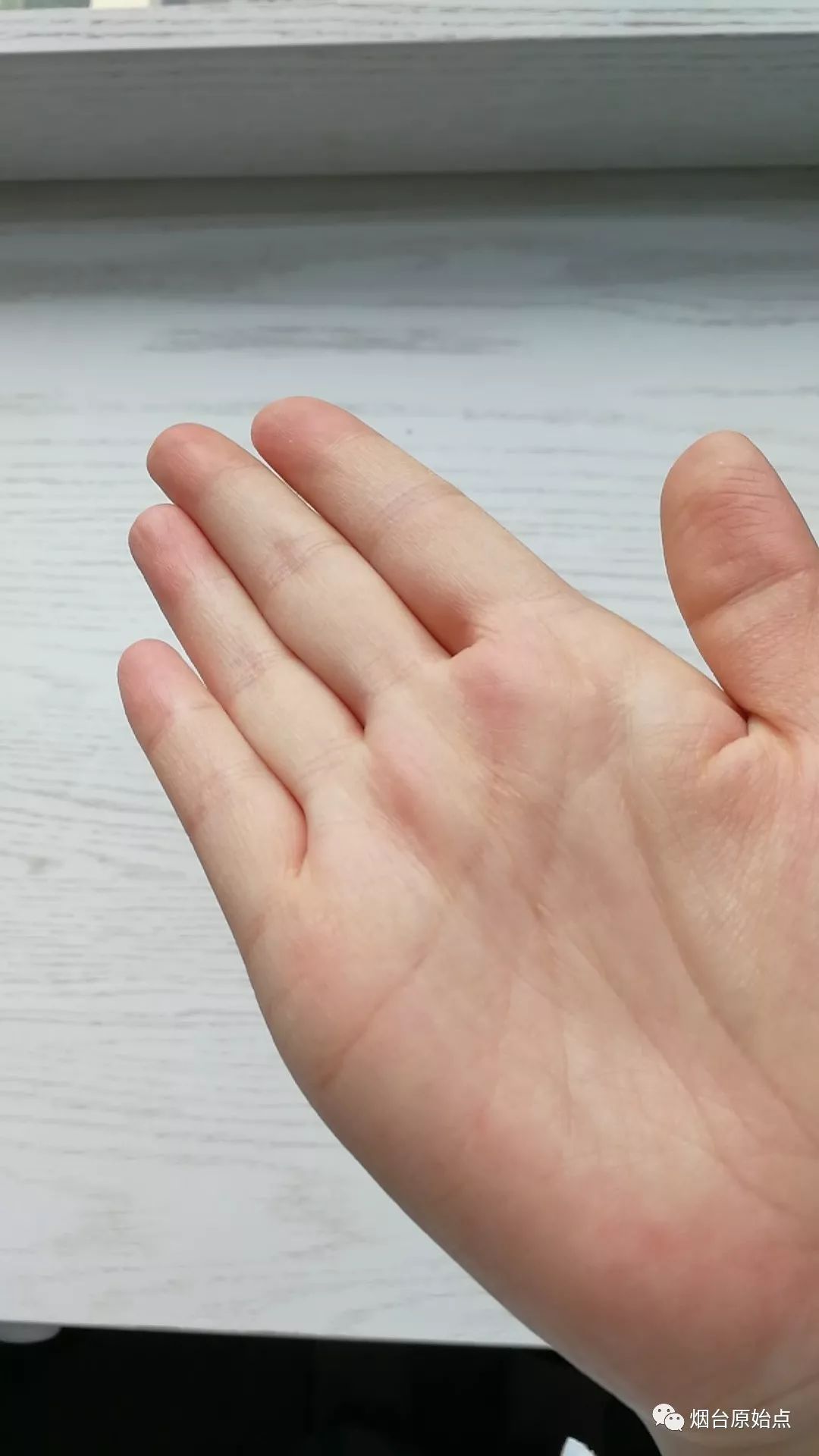 手指头血管瘤案例