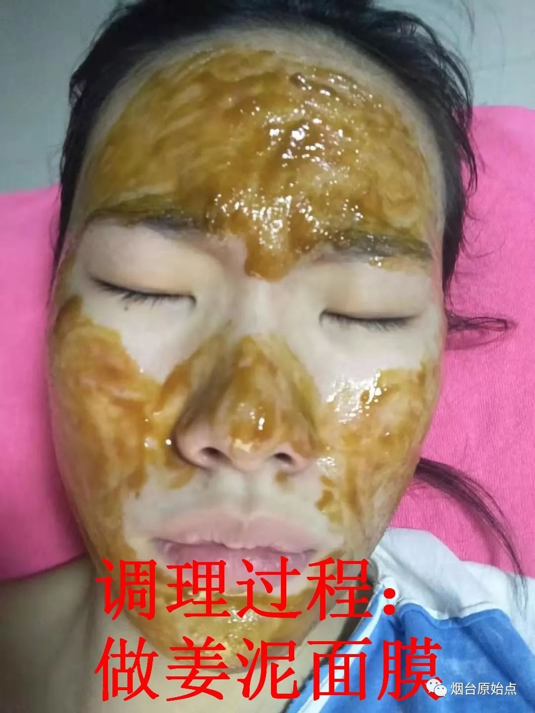 脸部痘痘案例 脸部痘痘案例