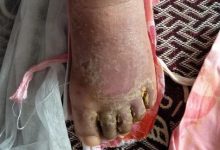 手脚、腿部浮肿案例-原始点全球同学网