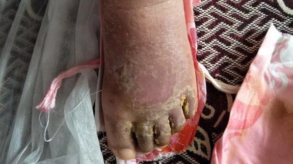 手脚、腿部浮肿案例-原始点全球同学网