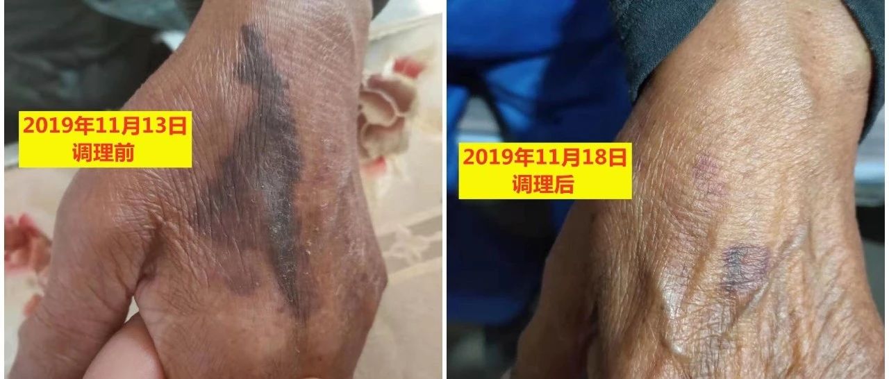糖尿病手部斑块案例-原始点全球同学网