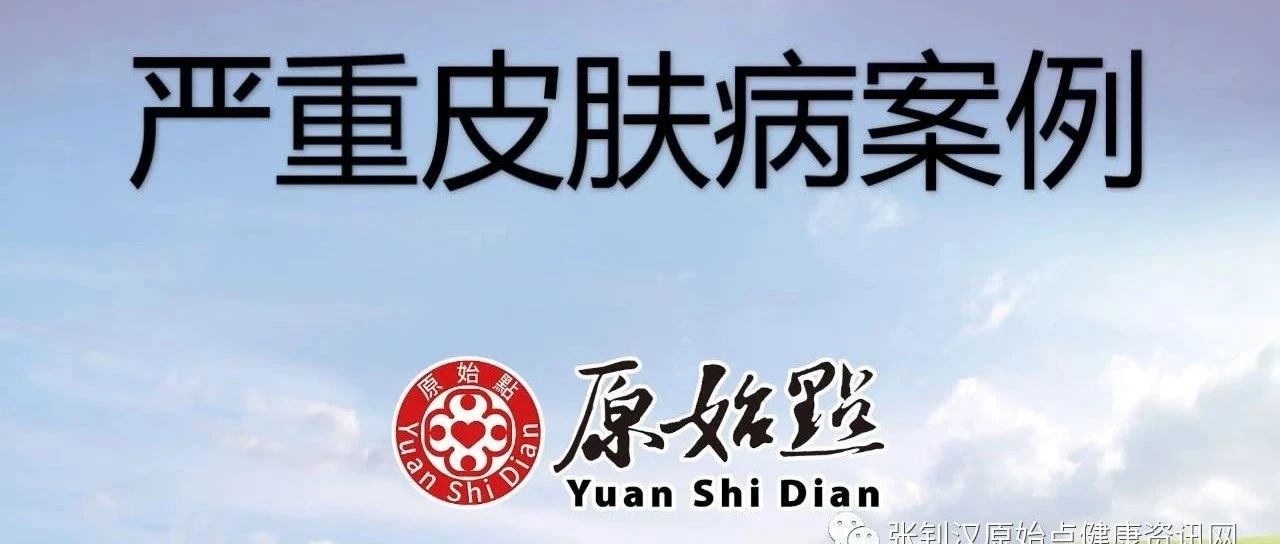 严重皮肤病案例 日期：2021/4/9-原始点全球同学网