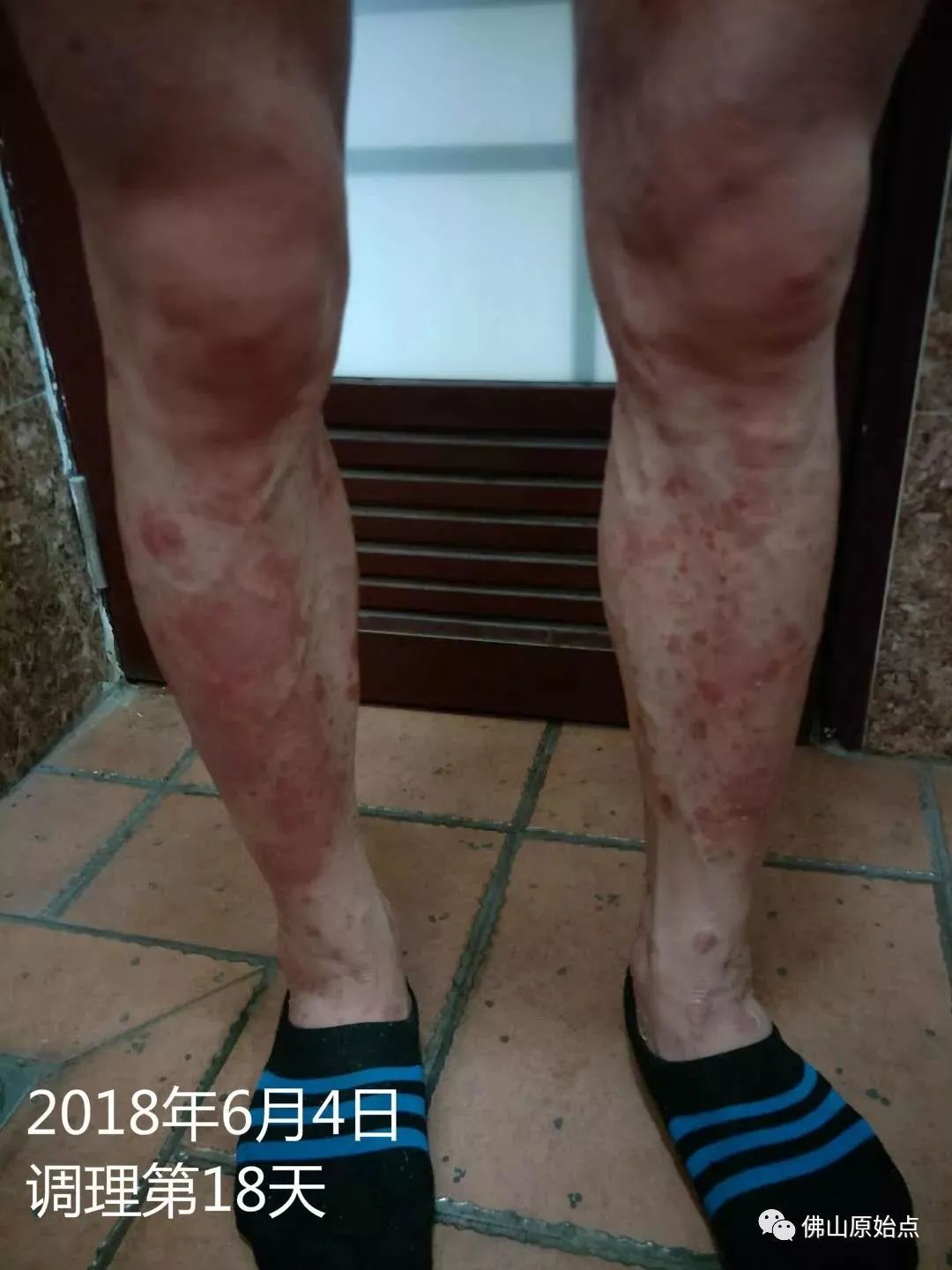 原始点调理严重牛皮癣及静脉曲张:84天完好如初 原始点调理严重牛皮癣及静脉曲张:84天完好如初