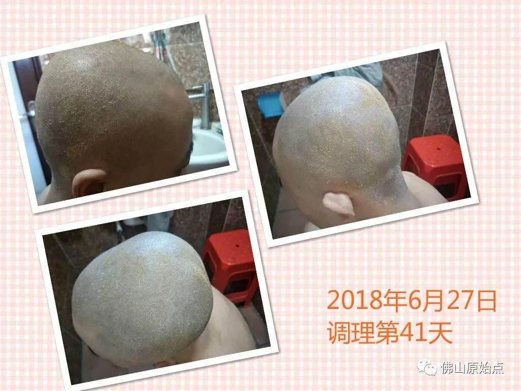 原始点调理严重牛皮癣及静脉曲张:84天完好如初 原始点调理严重牛皮癣及静脉曲张:84天完好如初