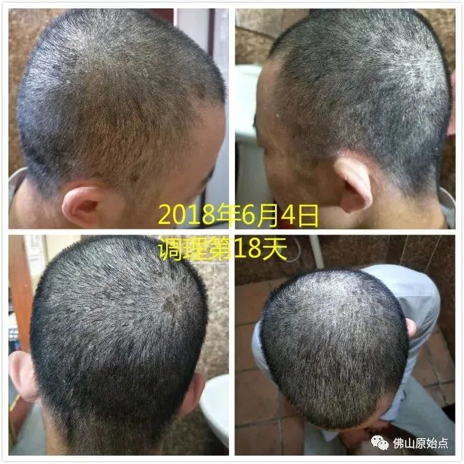 原始点调理严重牛皮癣及静脉曲张:84天完好如初 原始点调理严重牛皮癣及静脉曲张:84天完好如初